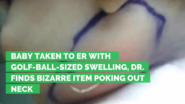 Baby Taken to ER with Golf-ball-Sized Swelling, Dr. Finds Bizarre Item Poking Out Neck