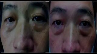 Xanthelasma, Syringoma, Moles Removal, Easy safe way to Xanthelasma, Syringoma, Moles Removal,