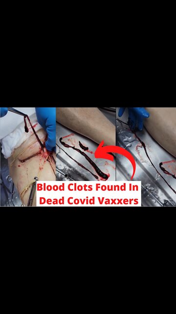 Unbelievable Blood Clots Found In Man Dead From Covid Vaccine