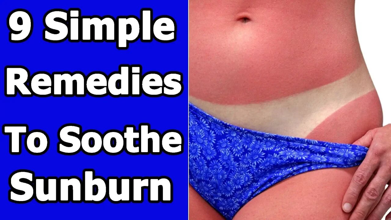 9 Simple Remedies To Soothe Sunburn