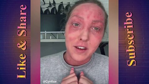 Woman Shows Vaccine side effects. "I was just following doctors orders and Government Mandates.”