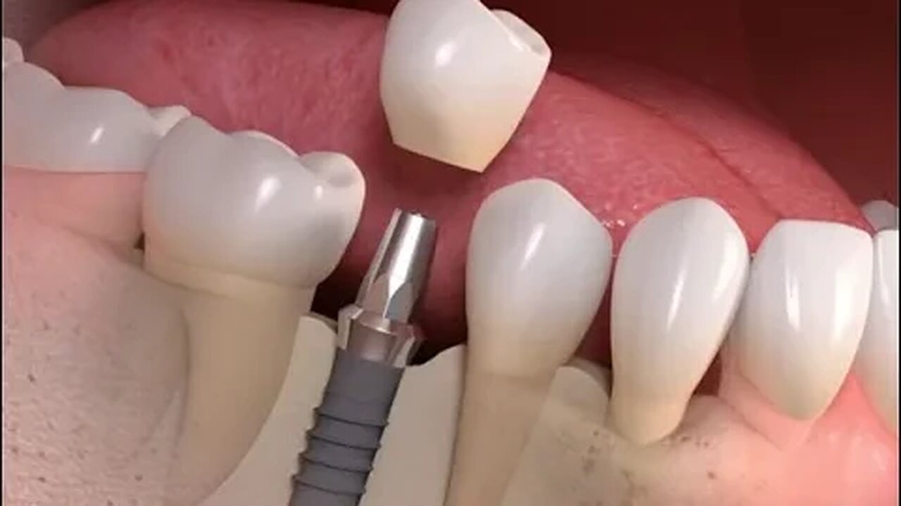 How to Remove a Cement Retained Implant Crown (Crown is Loose)