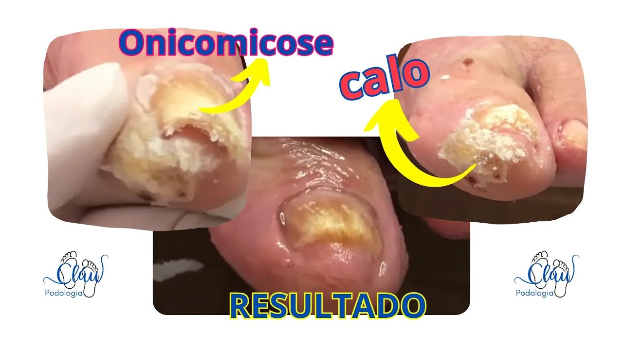 Unha ENCRAVADA e remoção de CALOS #unhas #pes #dor #podologia