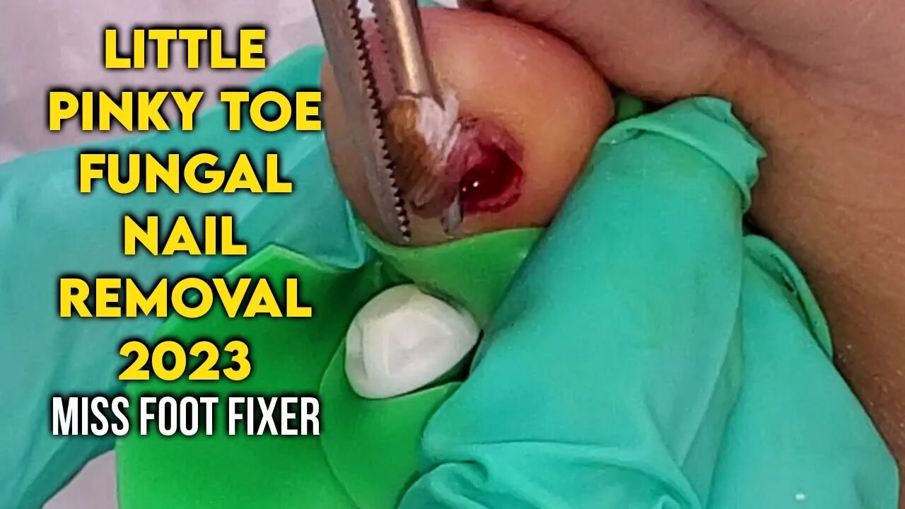 LITTLE PINKY TOE PERMANENT FUNGAL NAIL REMOVAL 2023 BY FAMOUS PODIATRIST MISS FOOT FIXER