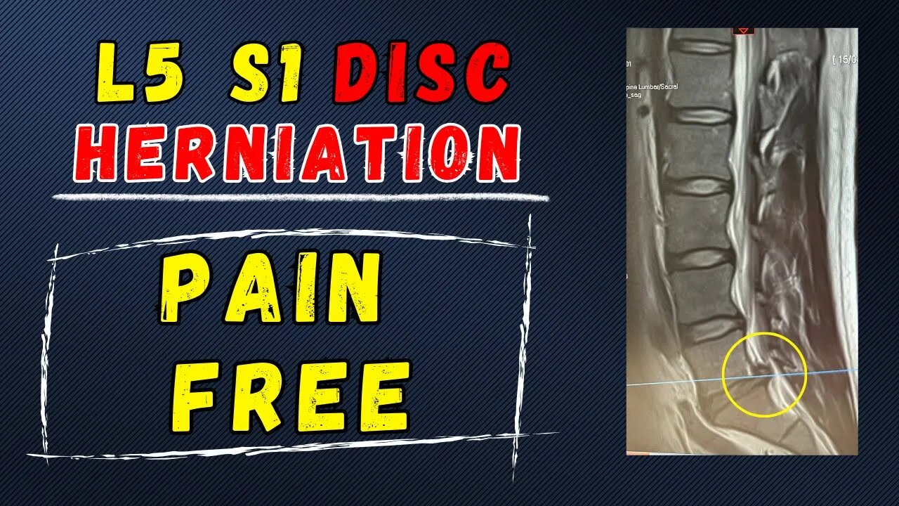 L5 S1 Disc Herniation Recovery without surgery