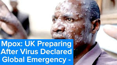 UK preparing after mpox virus declared global emergency