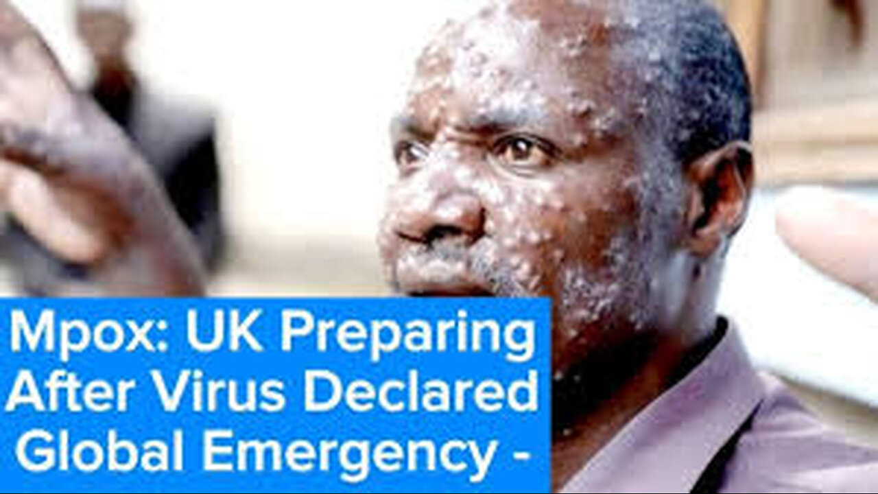 UK preparing after mpox virus declared global emergency