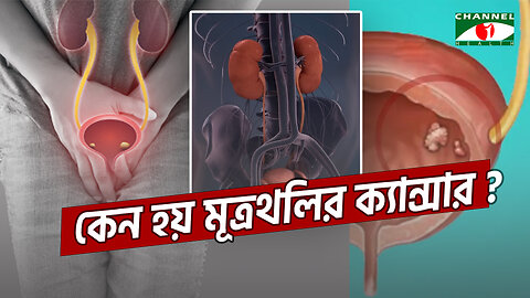 আপনারও হতে পারে মূত্রথলির ক্যান্সার | জেনে নিন প্রতিরোধে করণীয় | Bladder Cancer Symptoms and Cure