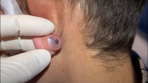 blackhead ears