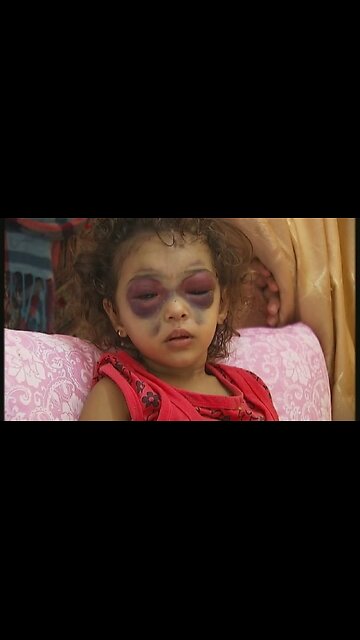 "Panda Eyes" Occur When Children Are Violently Sodomized & Jill Biden Knows This