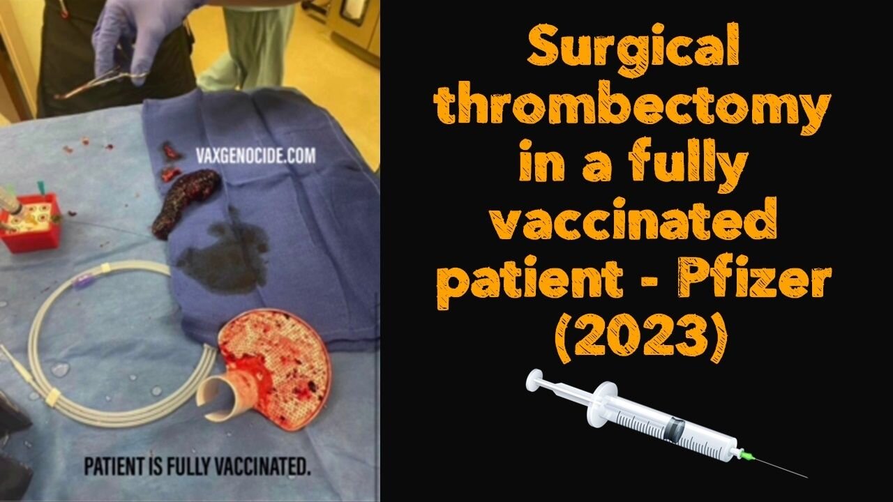 Surgical thrombectomy in a fully vaccinated patient - Pfizer (2023)