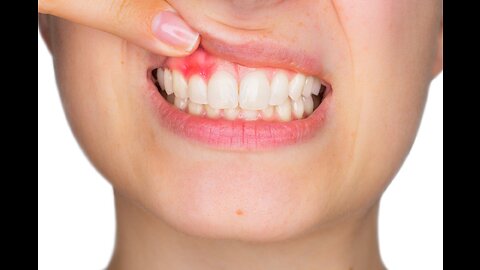 Get rid of tooth Decay and receding gums