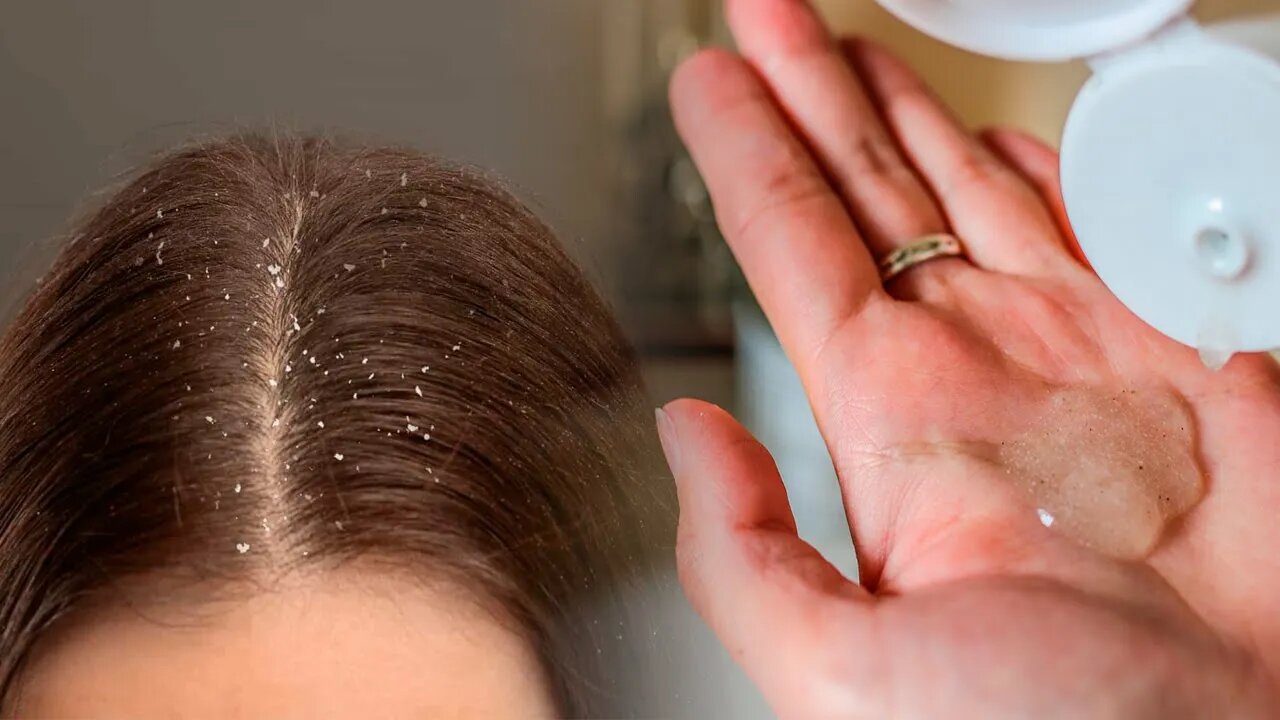 How to Make a Natural Anti-Dandruff Shampoo at Home