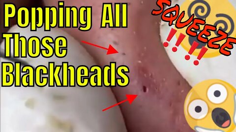 Squeeze that nose 👃 popping all those blackheads 🪱 #blackheadremoval #blackheadsqueezing #blackhead