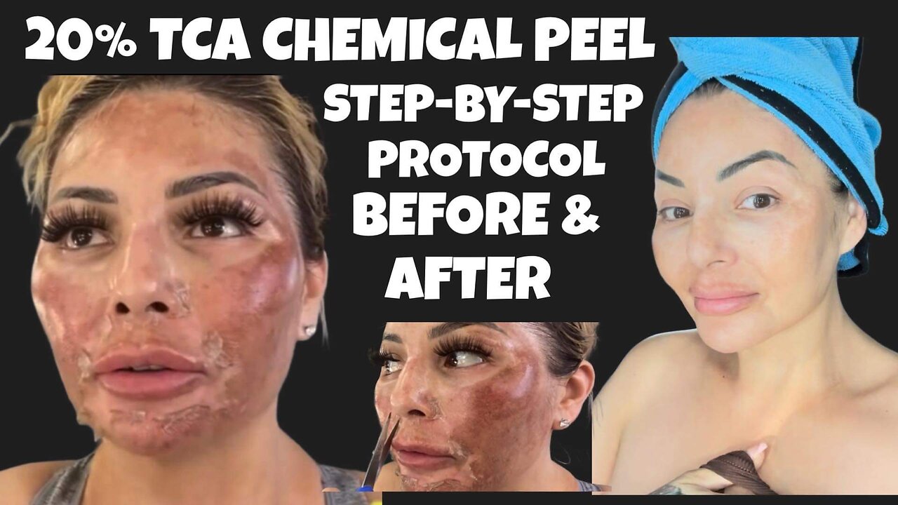 20% TCA protocol before an after. Omg I Burned My Skin.