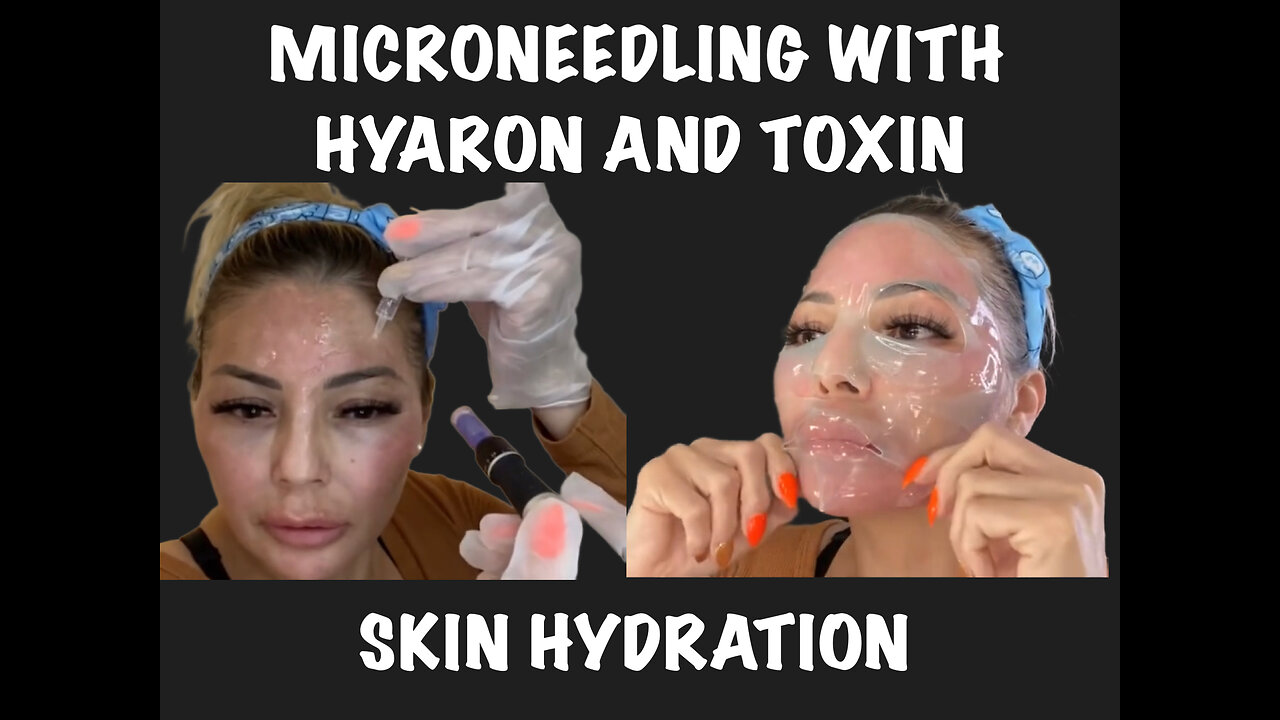 First Time Microneedling with Hyaron and Toxin