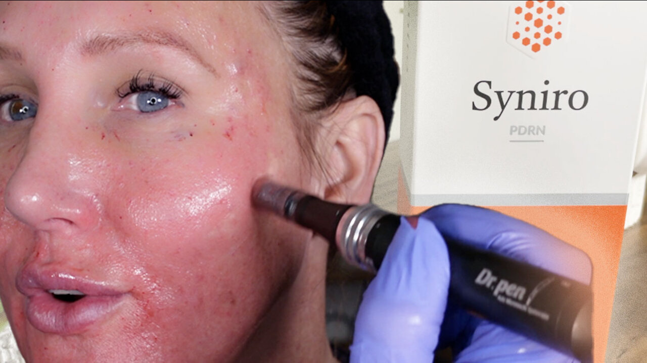 Syniro PDRN Microneedling | Gorgeously Aging