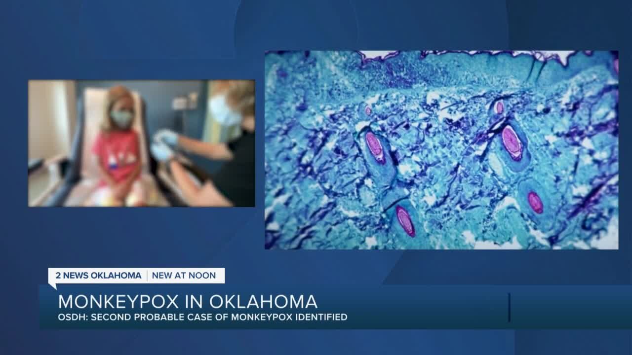 Second probable case of monkeypox in Oklahoma identified