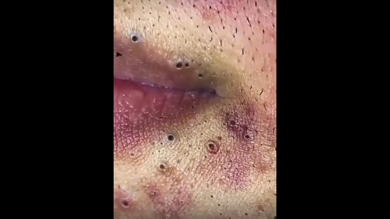 Jaw dropping blackhead popping around the lips 😨 #blackheadremoval #blackhead #blackheadpopping