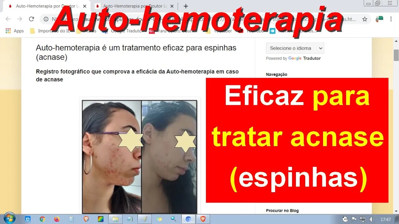 Auto-hemoterapia é um tratamento eficaz para espinhas (acnase). E proporcionou a melhora de rinite
