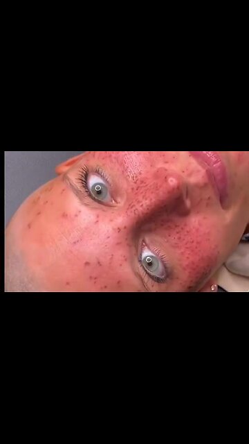 YOU WILL NEVER GUESS WHAT GEN Z IS GETTING TATTOOED ON THEIR FACES...LOOKS LIKE ACNE OR THE POX