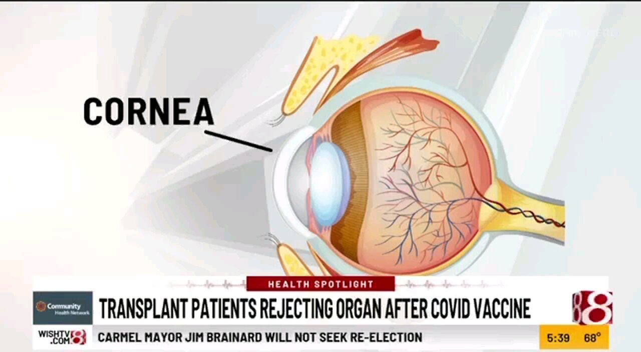 Corneal Transplants Being Rejected After Covid Shots