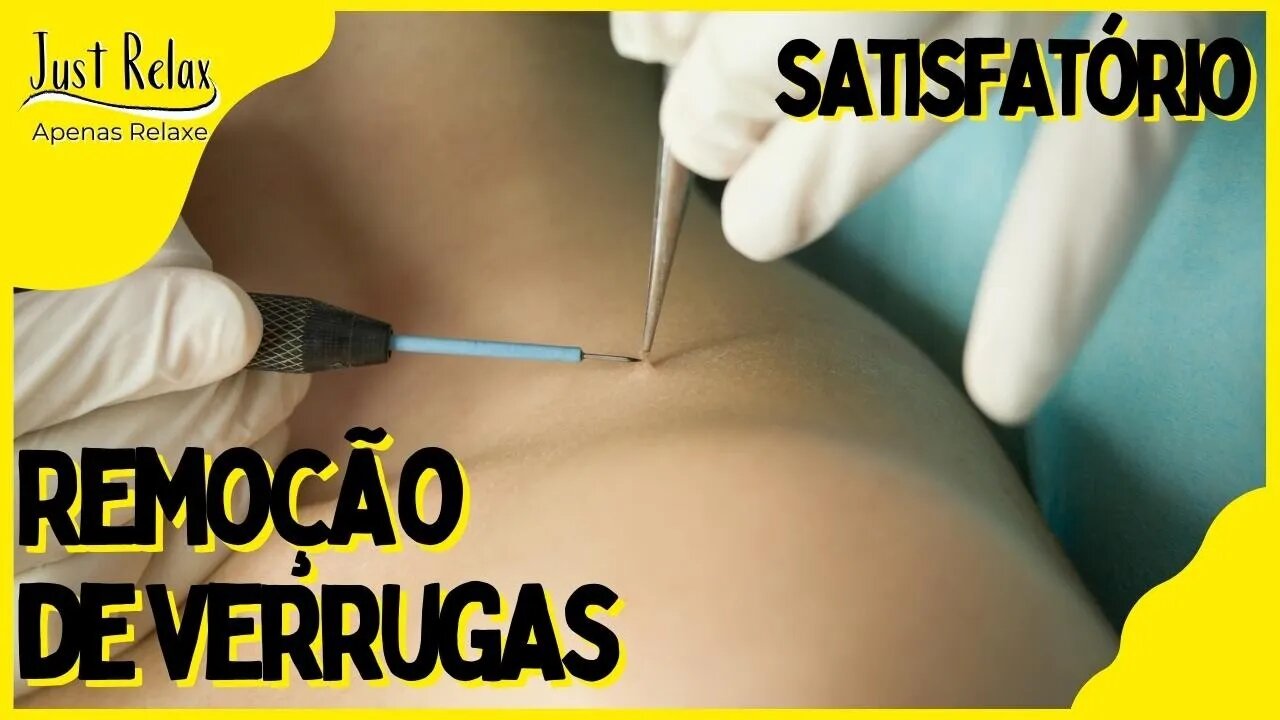 Remoção de Verrugas com Plasma - Satisfatório Verrugas com Plasma Asmr - Just Relax | Apenas Relaxe