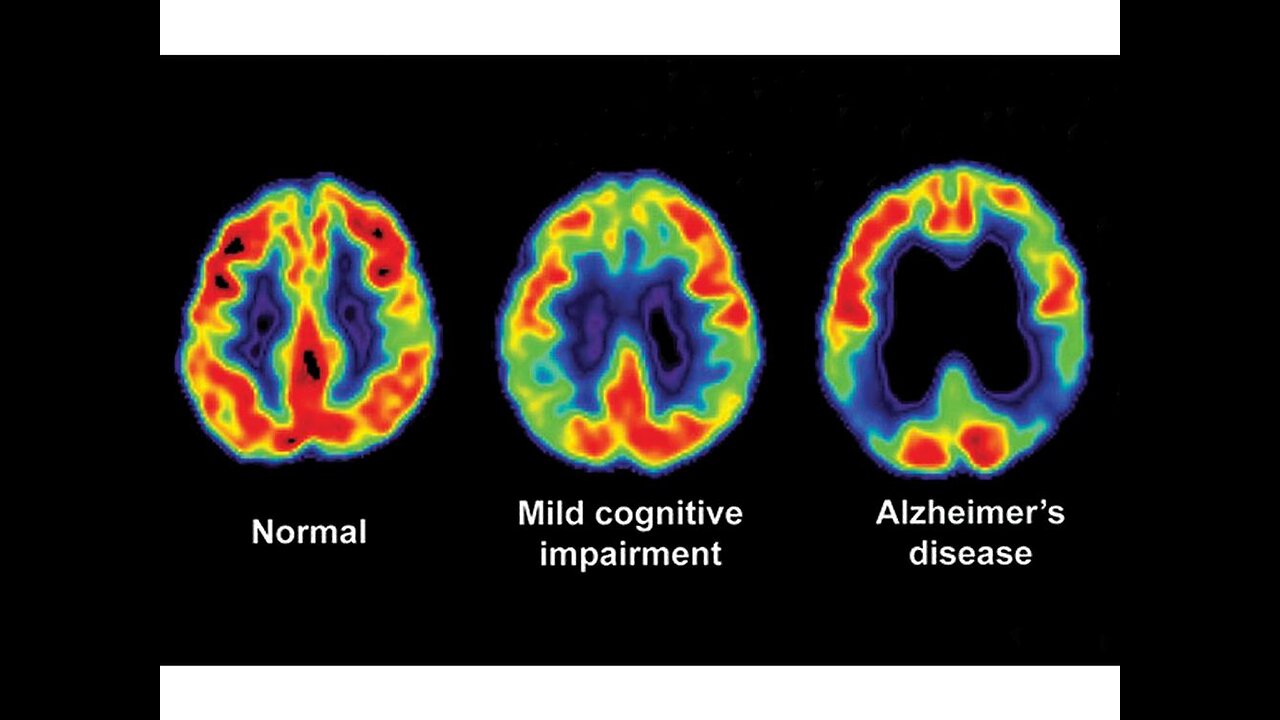 Unlocking Alzheimer's Disease: Recognizing the Signs and Symptom