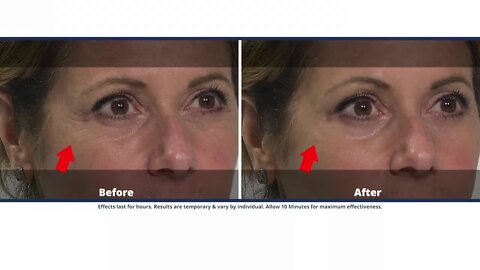 Reduce the signs of aging with Plexaderm