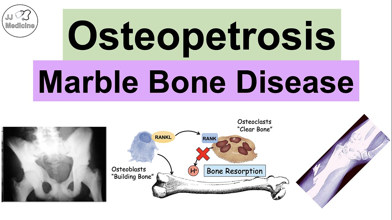 Osteopetrosis (Marble Bone Disease) | Causes, Symptoms, Diagnosis, Treatment