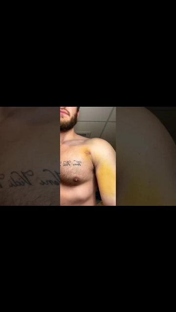 Bruising after a pec tear