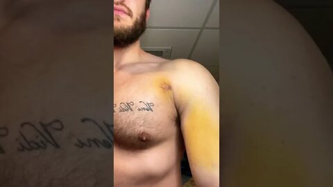 Bruising after a pec tear