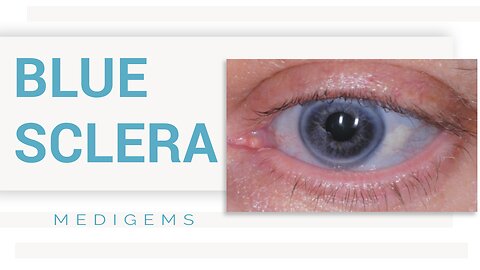 BLUE SCLERA - WHAT ARE THE CAUSES?