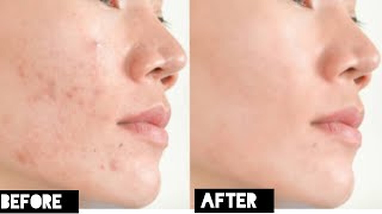 ACNE Treatment At Home | 3 day Acne REMOVAL Challenge | Acne Treatment by api ji k ideas