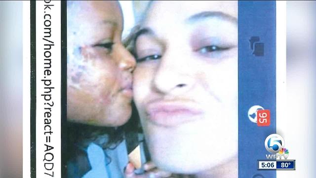 DCF sued after Palm Beach children burned with grease by guardian