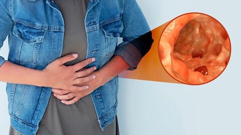 5 COMPLICAÇÕES DA DIVERTICULITE QUE VOCÊ DEVE CONHECER