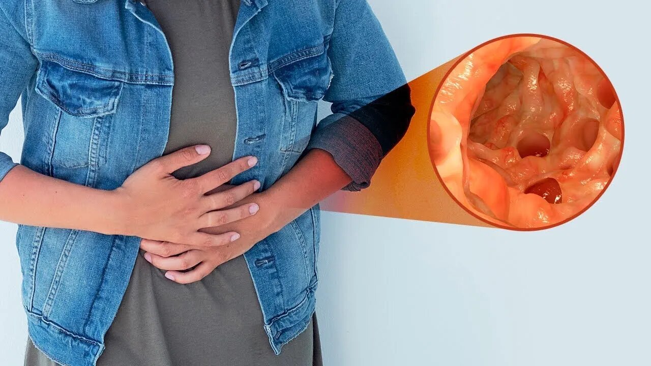 5 COMPLICAÇÕES DA DIVERTICULITE QUE VOCÊ DEVE CONHECER