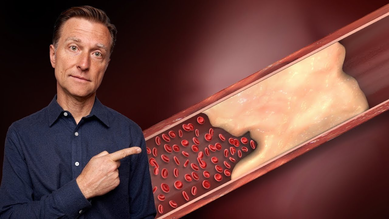 Why Your Arteries are Calcifying and Turning into Bones - The REAL Reason