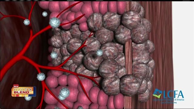 Lung Cancer Patients