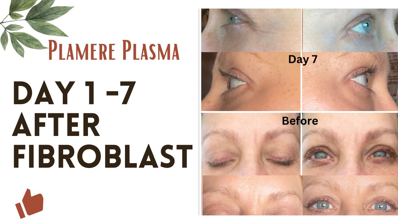 Day 1 -7 after Fibroblast Treatment with the Plamere Plasma Pen