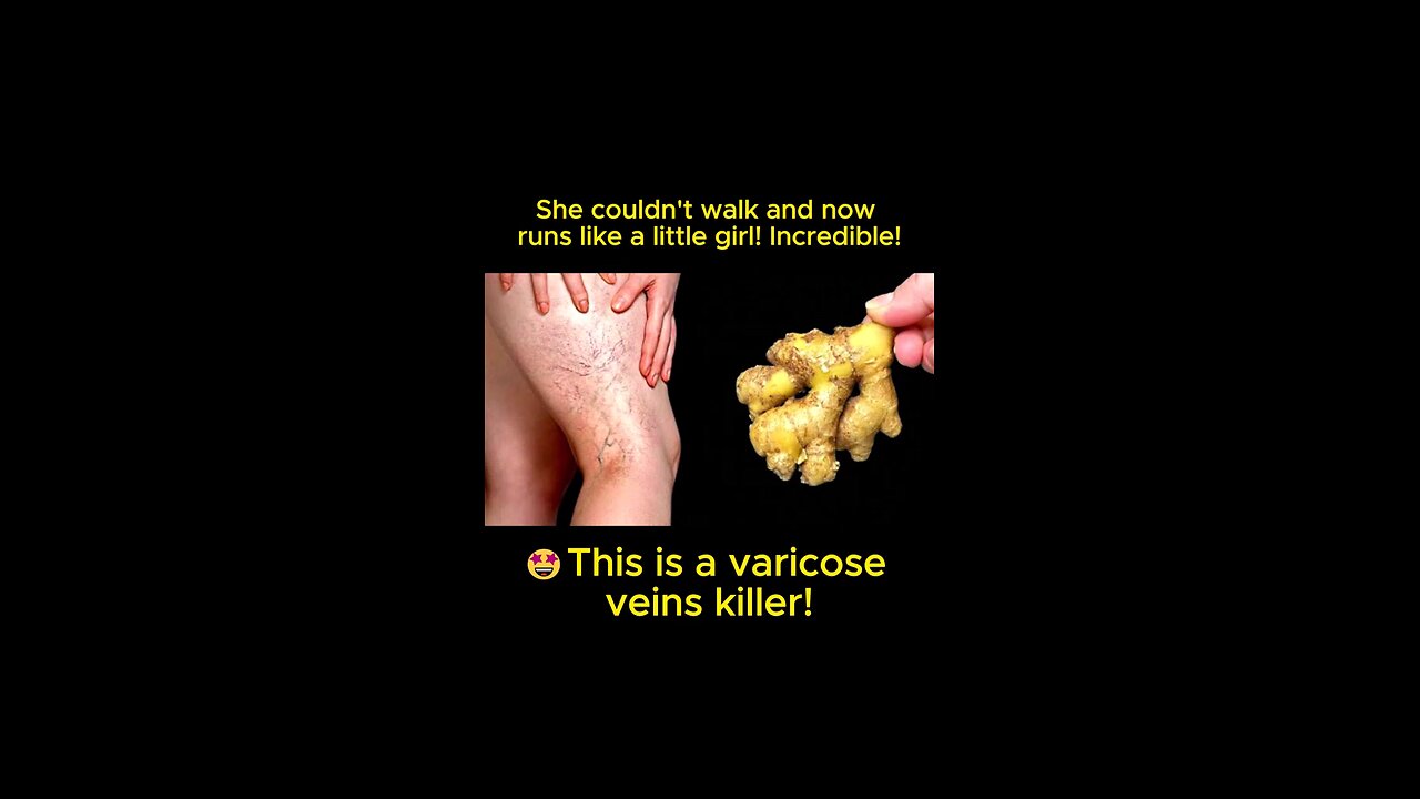 varicose veins killer home remedy