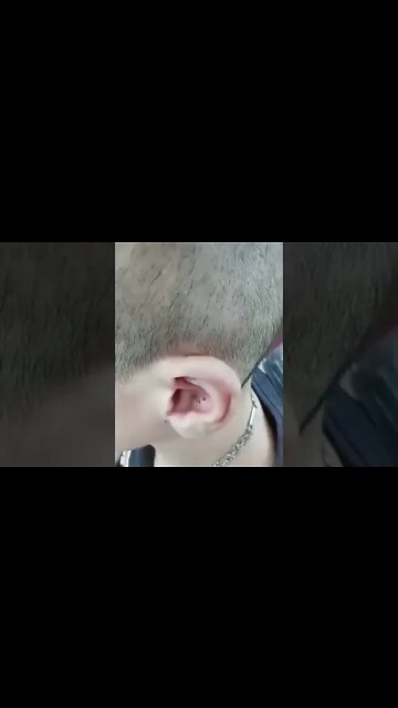 Extraction Blackhead Ear Removal