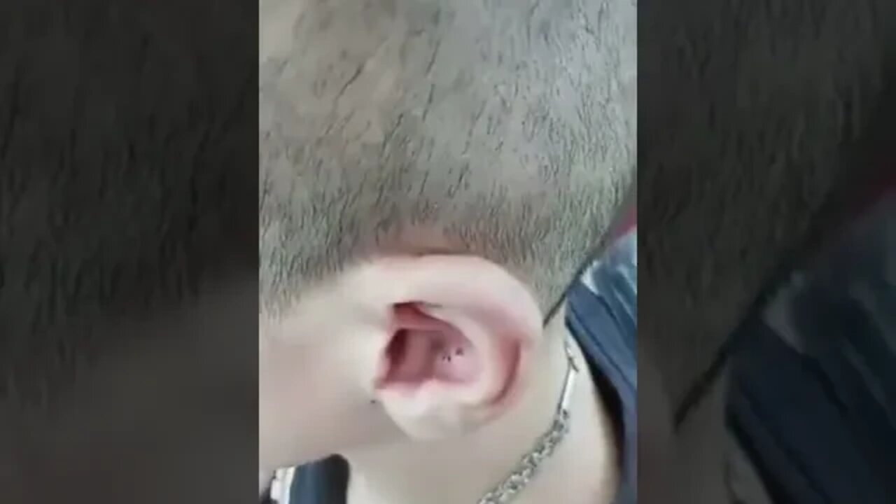 Extraction Blackhead Ear Removal