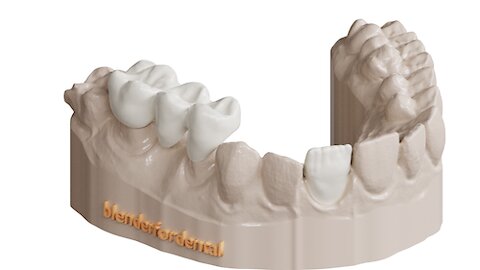 Blenderfordental - Crown & Bridge Module