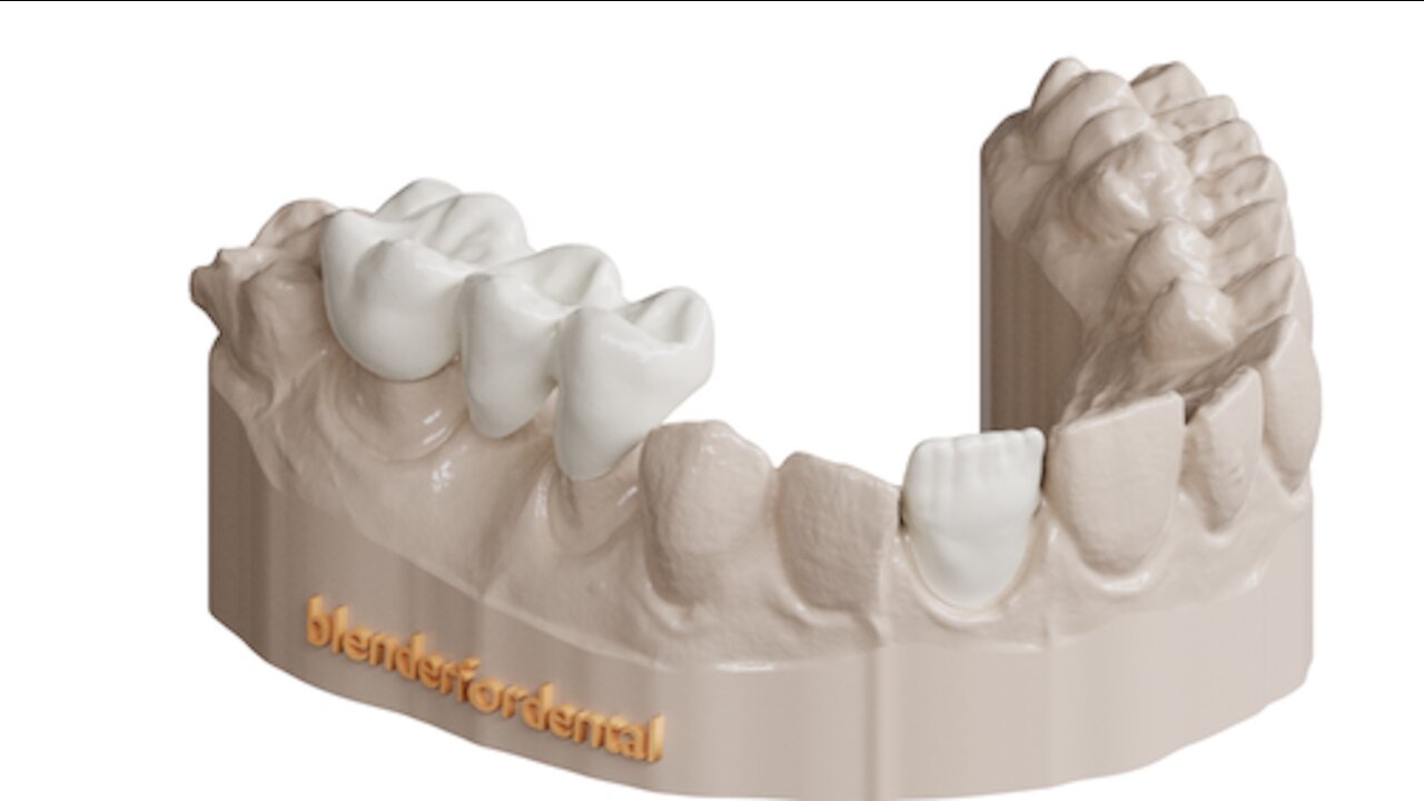 Blenderfordental - Crown & Bridge Module