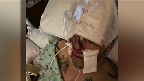 Deputy has face reconstructed after drunk driver hits him on the side of the road