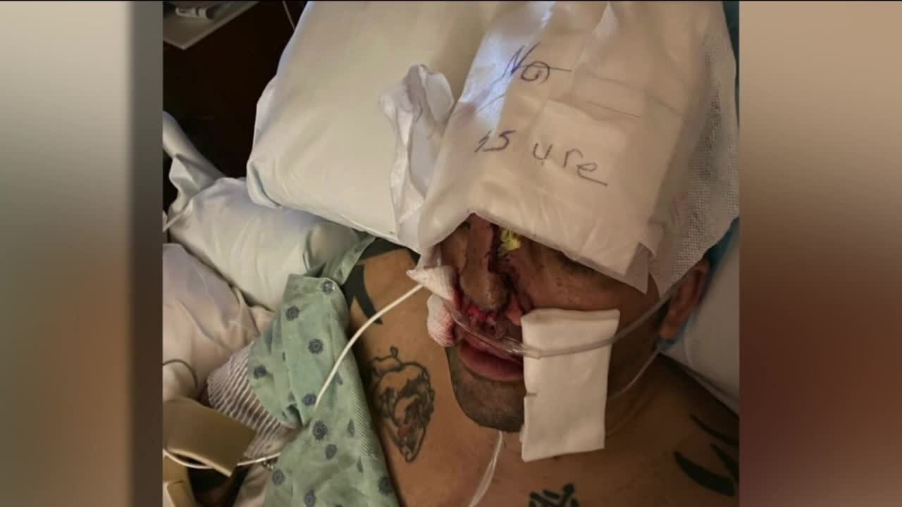 Deputy has face reconstructed after drunk driver hits him on the side of the road