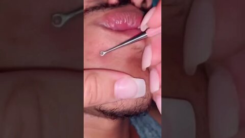 Satisfactory Video Blackhead Removal Skin Cleansing #15 | 2022 Video