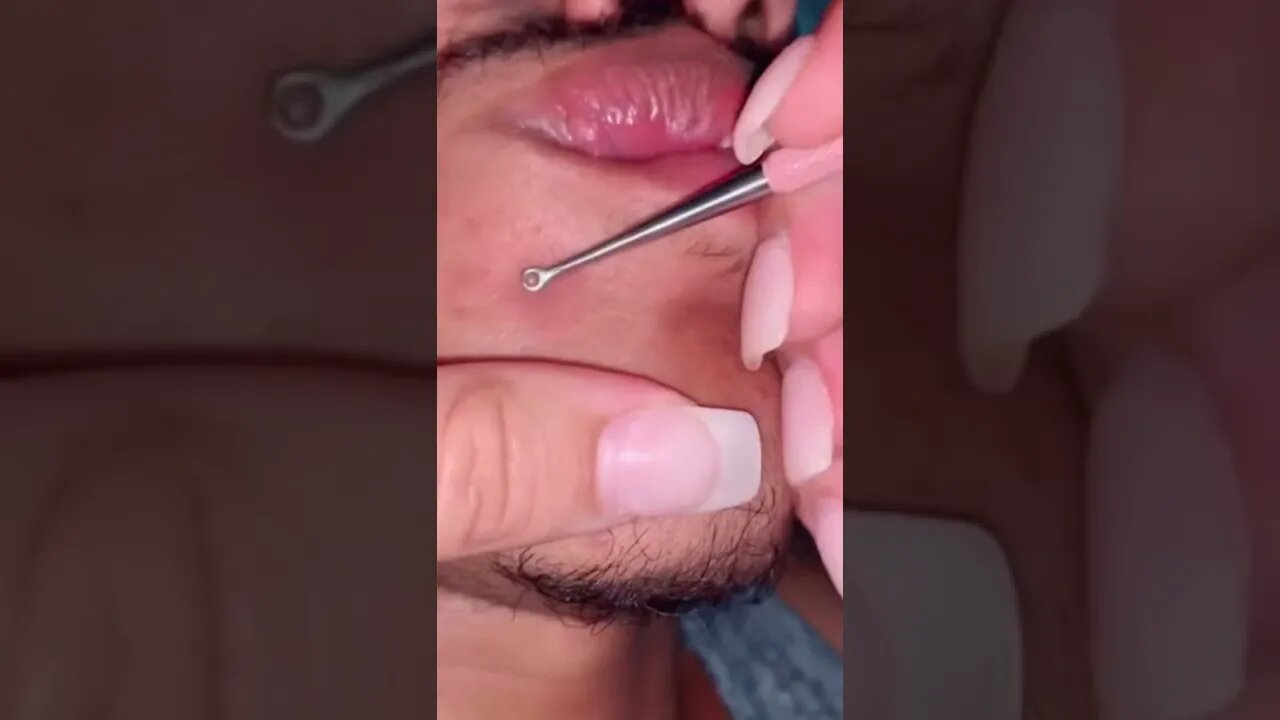 Satisfactory Video Blackhead Removal Skin Cleansing #15 | 2022 Video