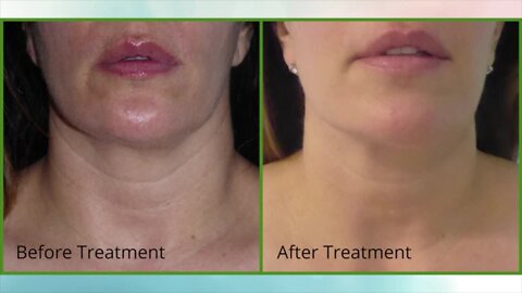 See the difference! Turn Back Time Spa & Wellness Clinic offers Vivace for your skin with great results